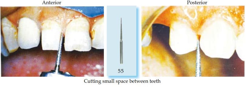 Special Diamond Bur (Proximal Surface of Teeth)