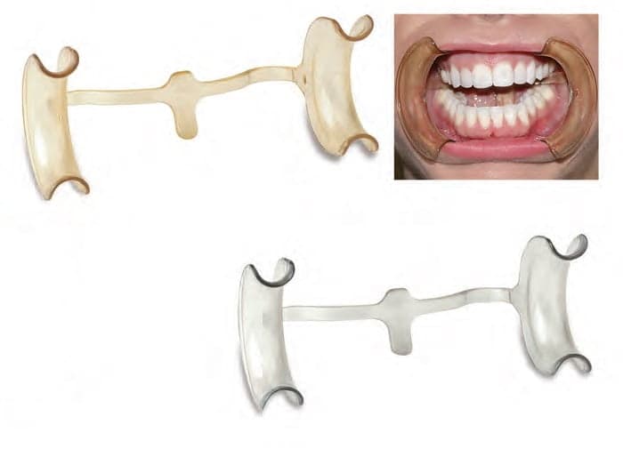 Cheek Retractor